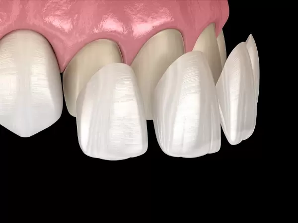 Dental-Laminates-in-hyderabad-2