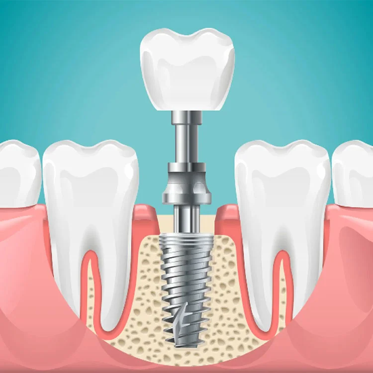 dental-implants-clinic-hyderabad-bangalore