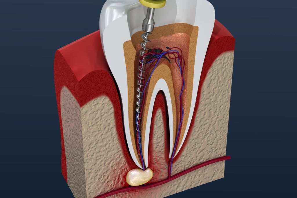 root-canal